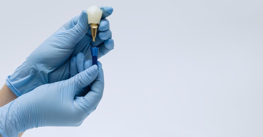 Chirurgien-dentiste posant un biomatériau lors d'une régénération osseuse guidée pour implant dentaire