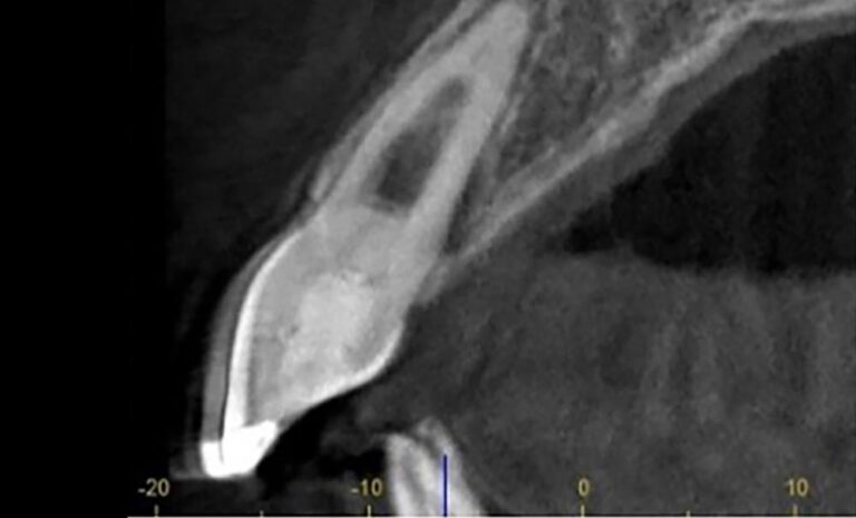 Praticien réalisant une endodontie connectée sous microscope opératoire avec limes NiTi rotatives dans un cabinet dentaire moderne