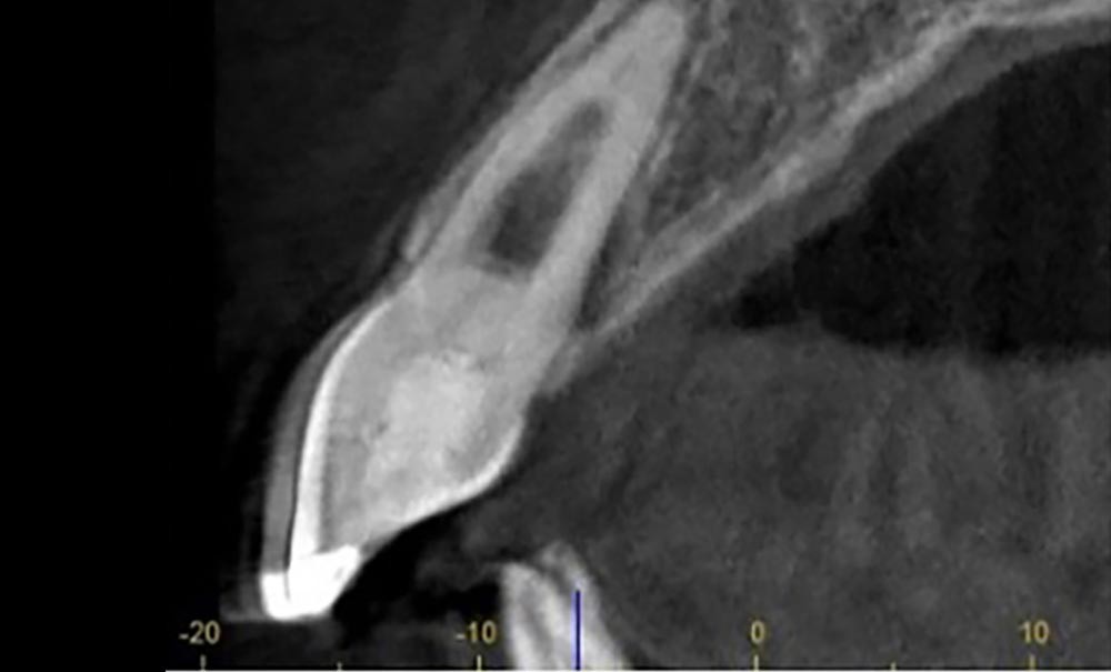 Praticien réalisant une endodontie connectée sous microscope opératoire avec limes NiTi rotatives dans un cabinet dentaire moderne