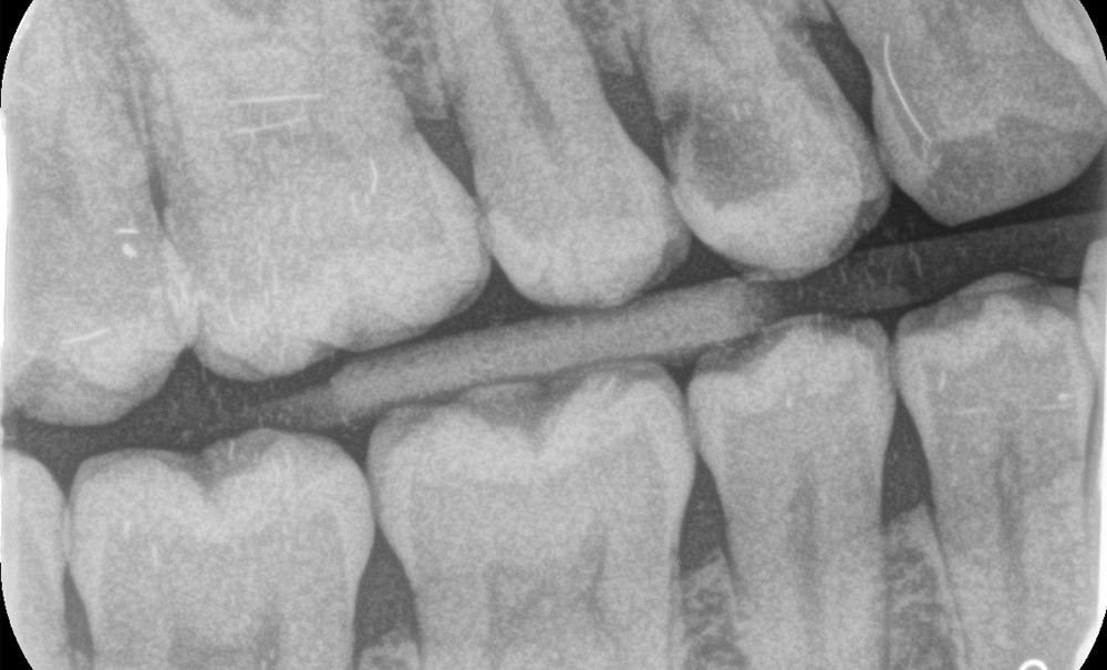 Dentiste utilisant un scanner intra-oral à transillumination infrarouge pour la détection précoce des caries, avec carte de fluorescence affichée à l'écran