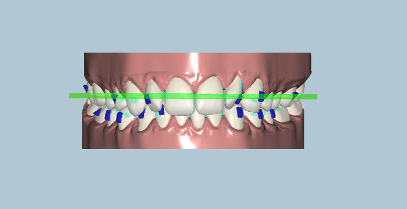 Orthodontiste utilisant un logiciel de planification pour la production d'aligneurs in-office avec impression 3D dans un cabinet dentaire moderne