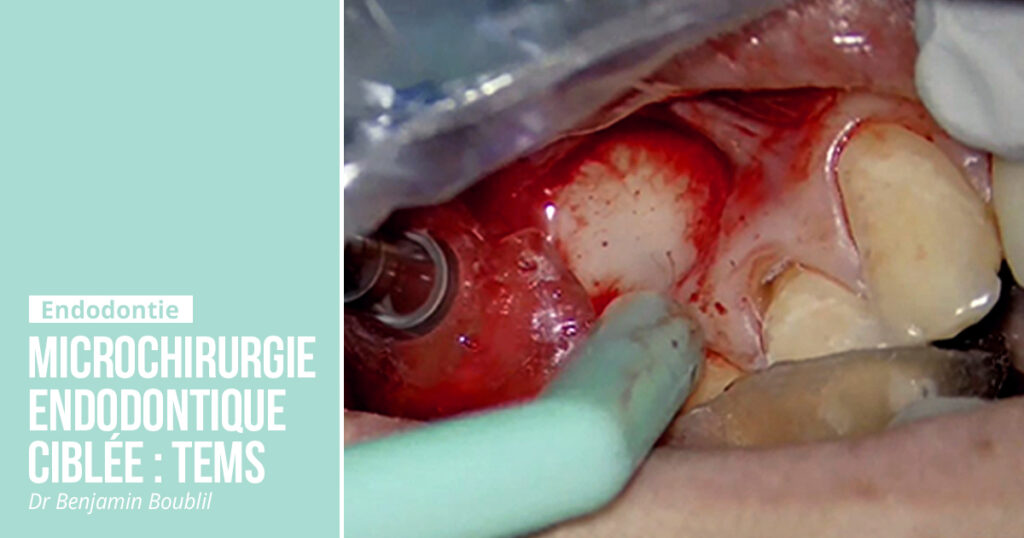Praticien réalisant une microchirurgie endodontique guidée sous microscope opératoire, avec guide chirurgical 3D et imagerie CBCT à l'écran